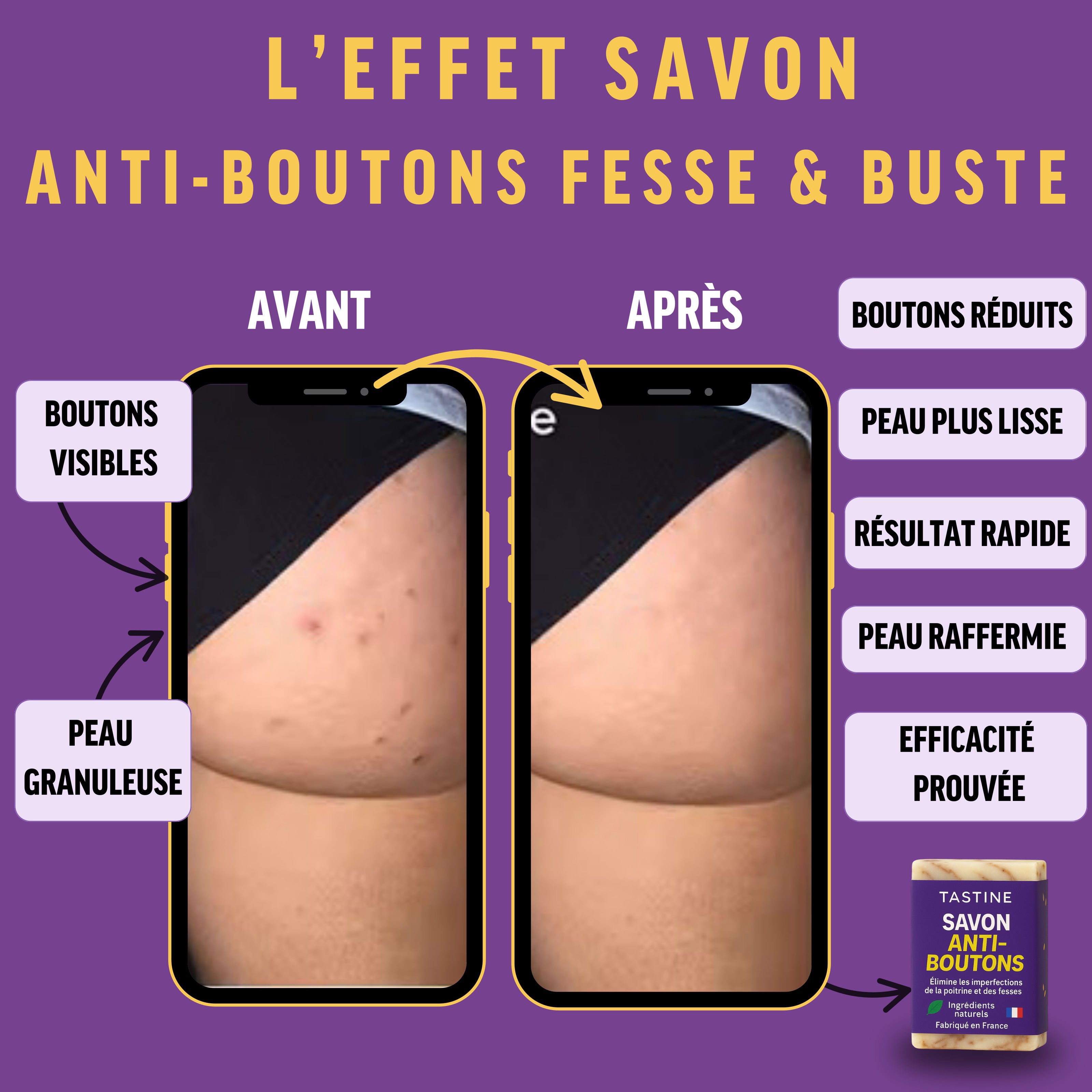 Avant et après l'utilisation du savon anti-boutons pour buste et fesses, montrant une peau plus lisse et des boutons réduits.